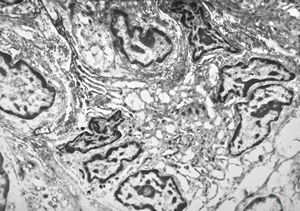 F,41y. | synovial metaplasia - capsule of implantate